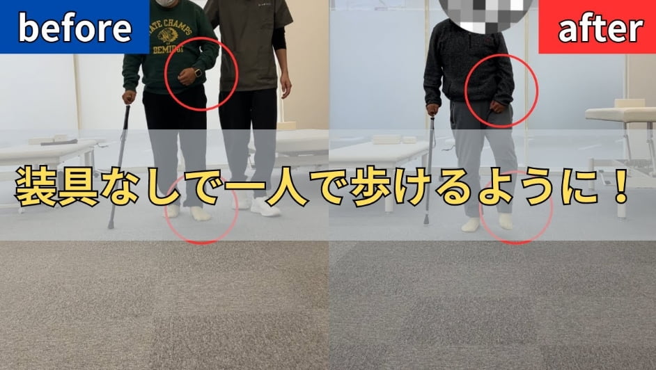 【発症2年】50代・脳梗塞・左片麻痺・歩行【1ヶ月での変化】